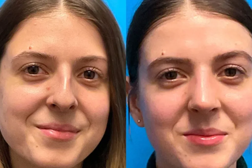 Nose Job Before and After