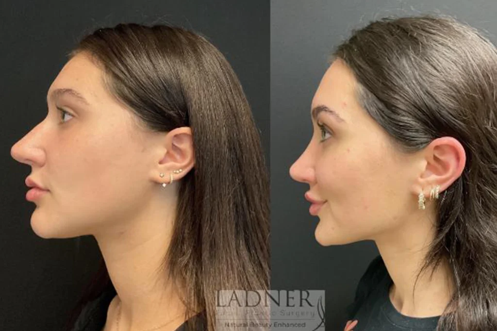 Nose Job Before and After