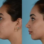 Nose Job Before and After