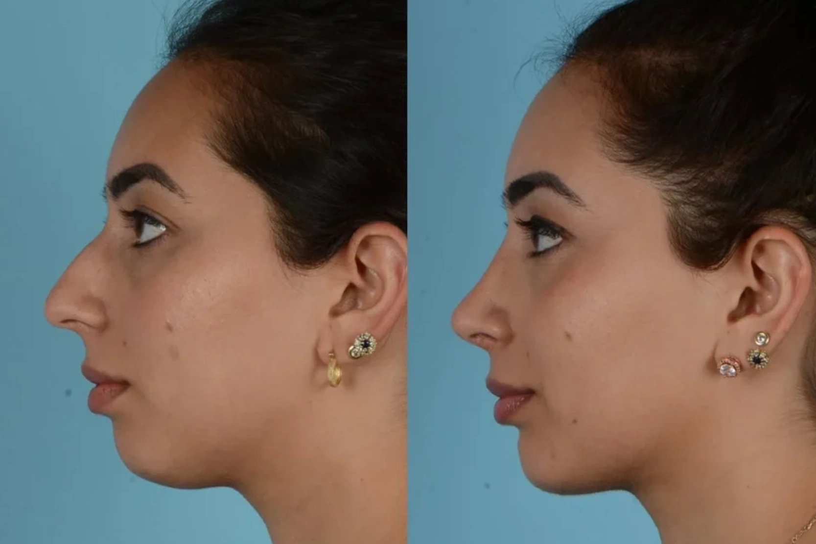 Nose Job Before and After