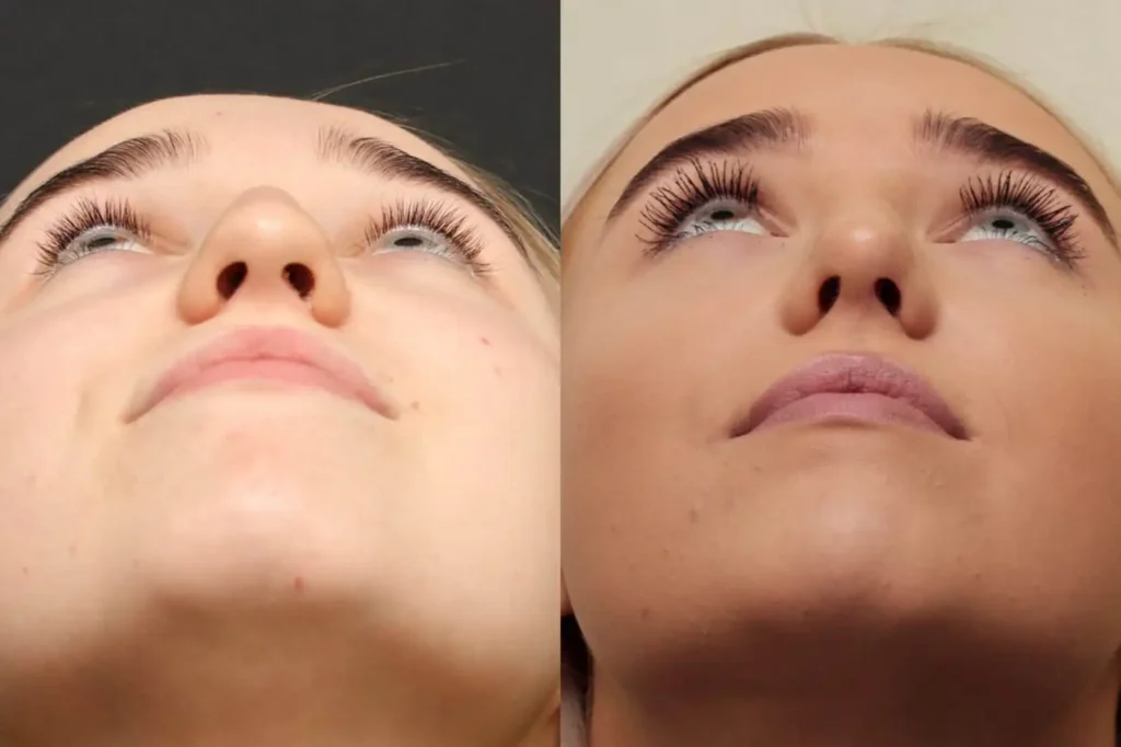 Rhinoplasty Before and After