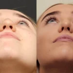 Rhinoplasty Before and After