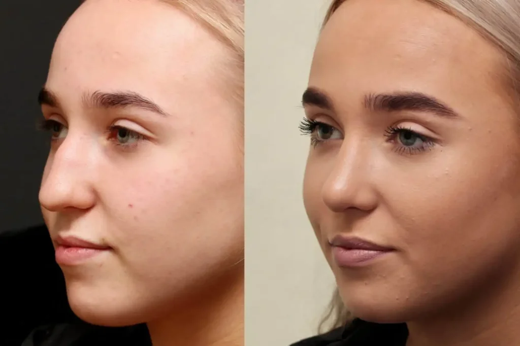 Rhinoplasty Before and After