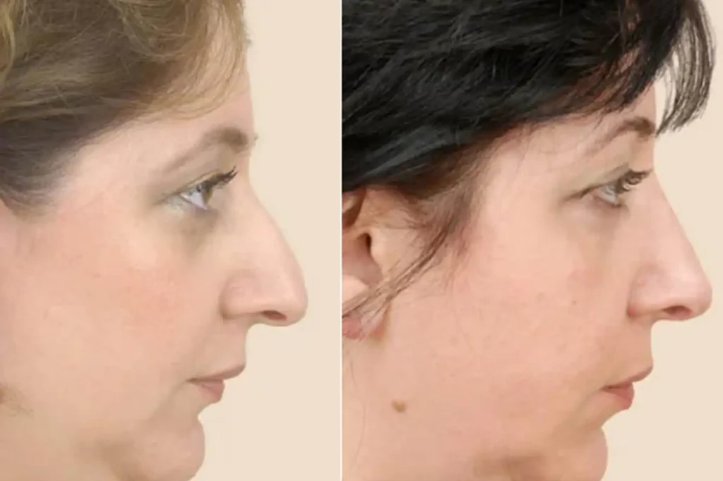 Rhinoplasty Recovery Day by Day