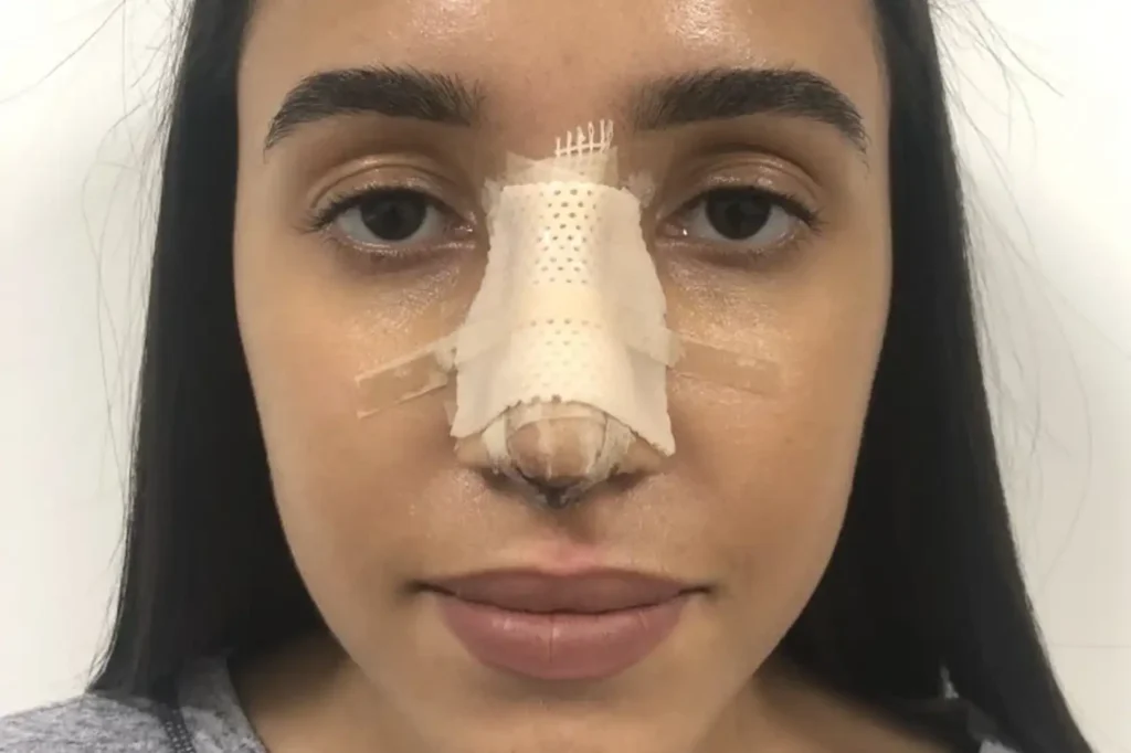 Rhinoplasty Recovery Day by Day