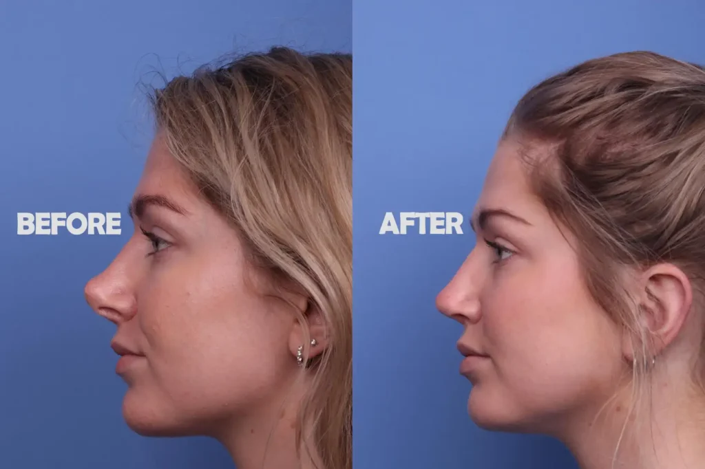 The Best Clinic for Rhinoplasty in the USA