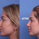 The Best Clinic for Rhinoplasty in the USA