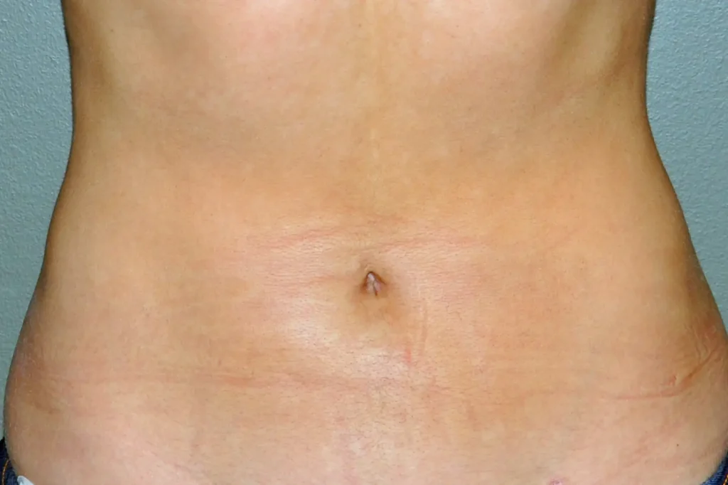 belly button cosmetic surgery before and after