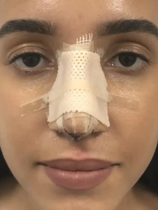 Rhinoplasty Recovery Day by Day