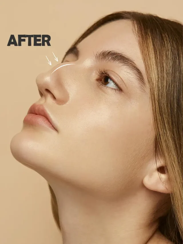 Nose Job Recovery Time