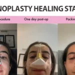 rhinoplasty healing stages