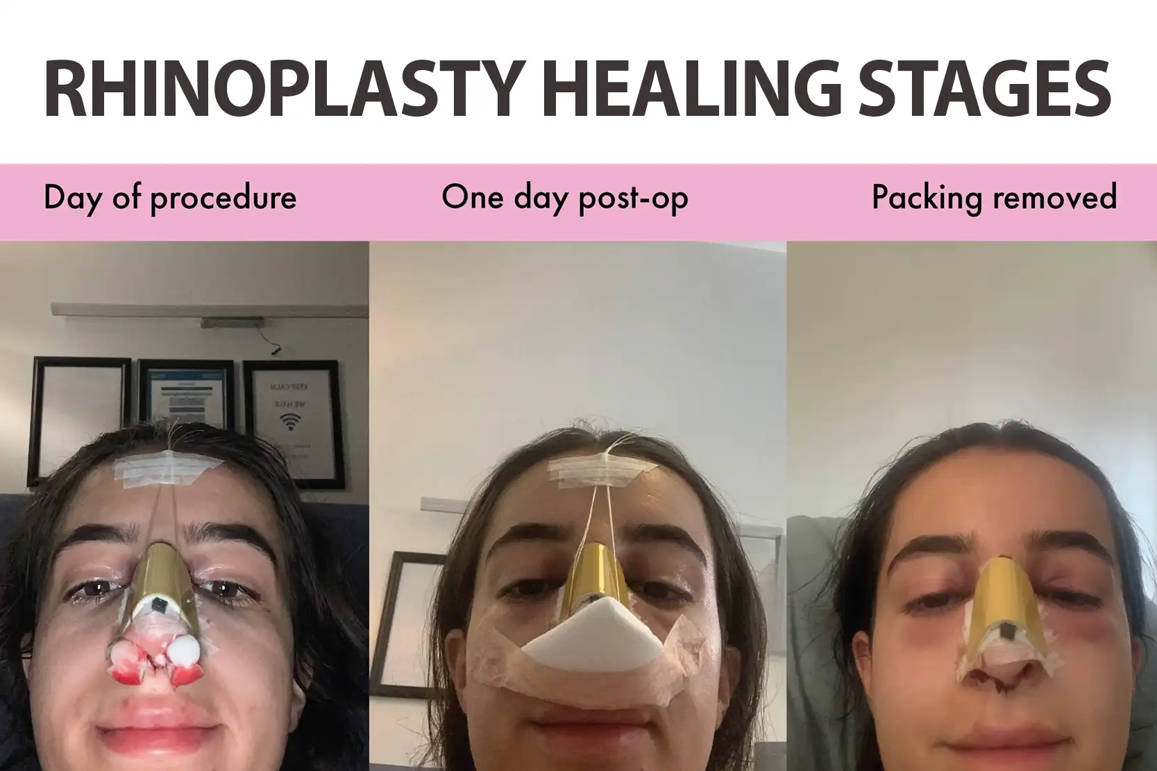 rhinoplasty healing stages