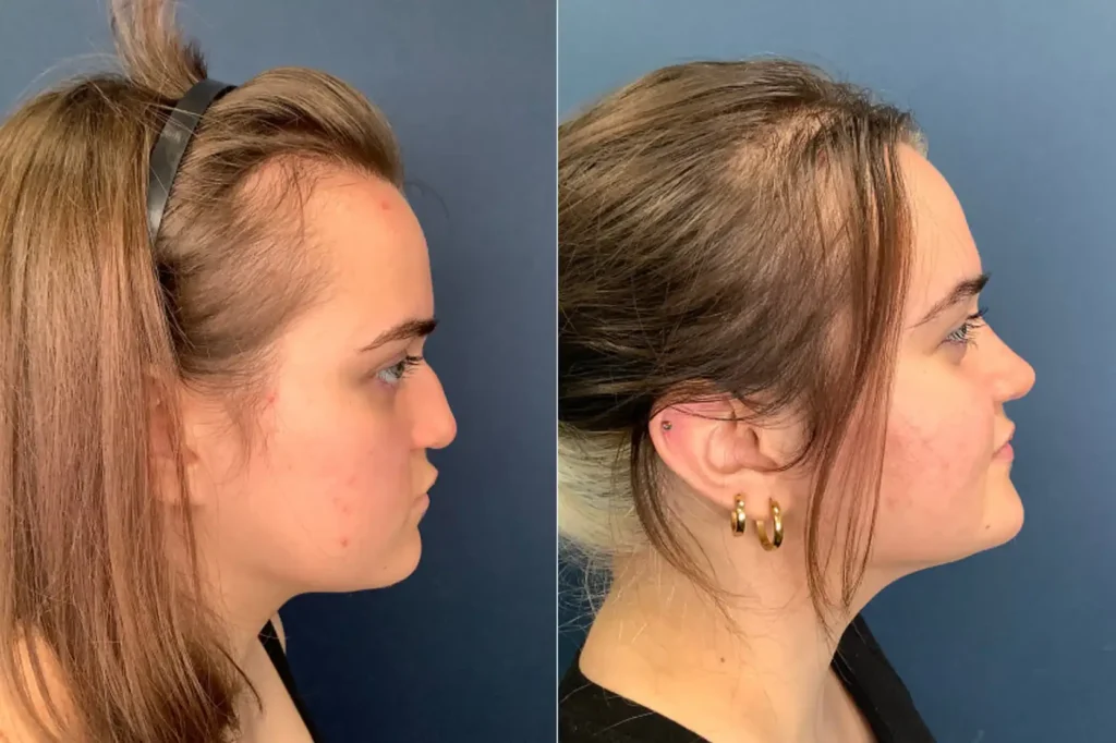 rhinoplasty healing stages