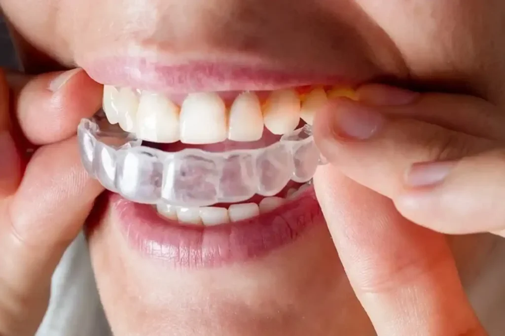 Does Insurance Cover Invisalign