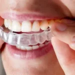 Does Insurance Cover Invisalign