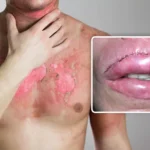 Lips Burning Cosmetic Surgery