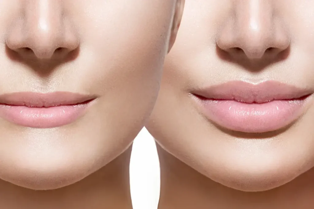 Lips Burning Cosmetic Surgery