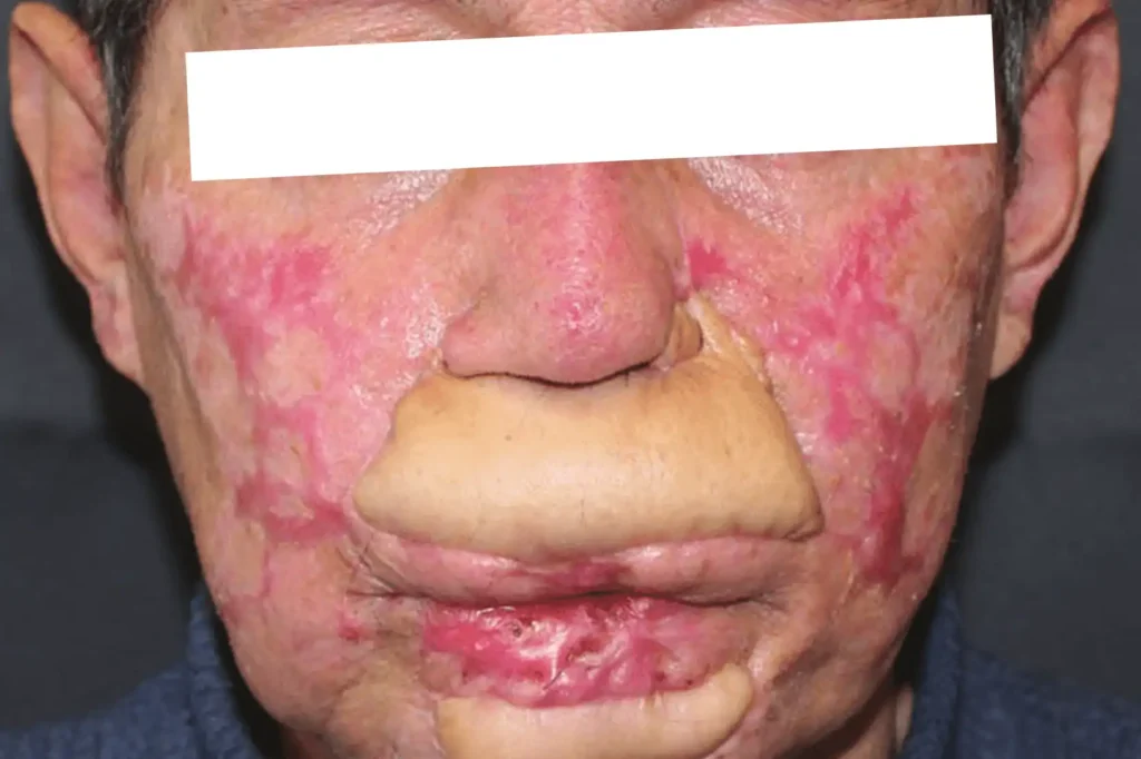 no lips burn victim cosmetic surgery