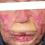 no lips burn victim cosmetic surgery