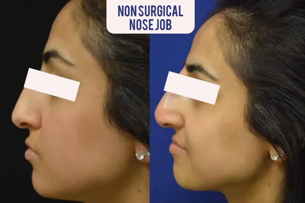 non surgical nose job