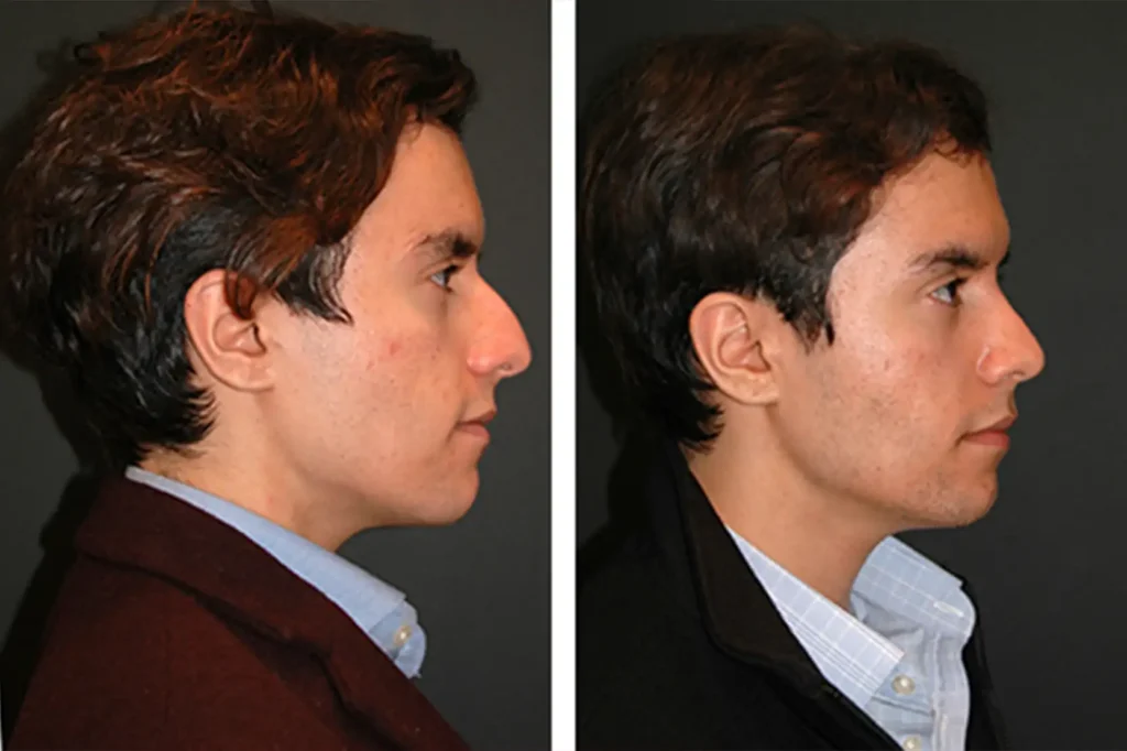 rhinoplasty before and after male