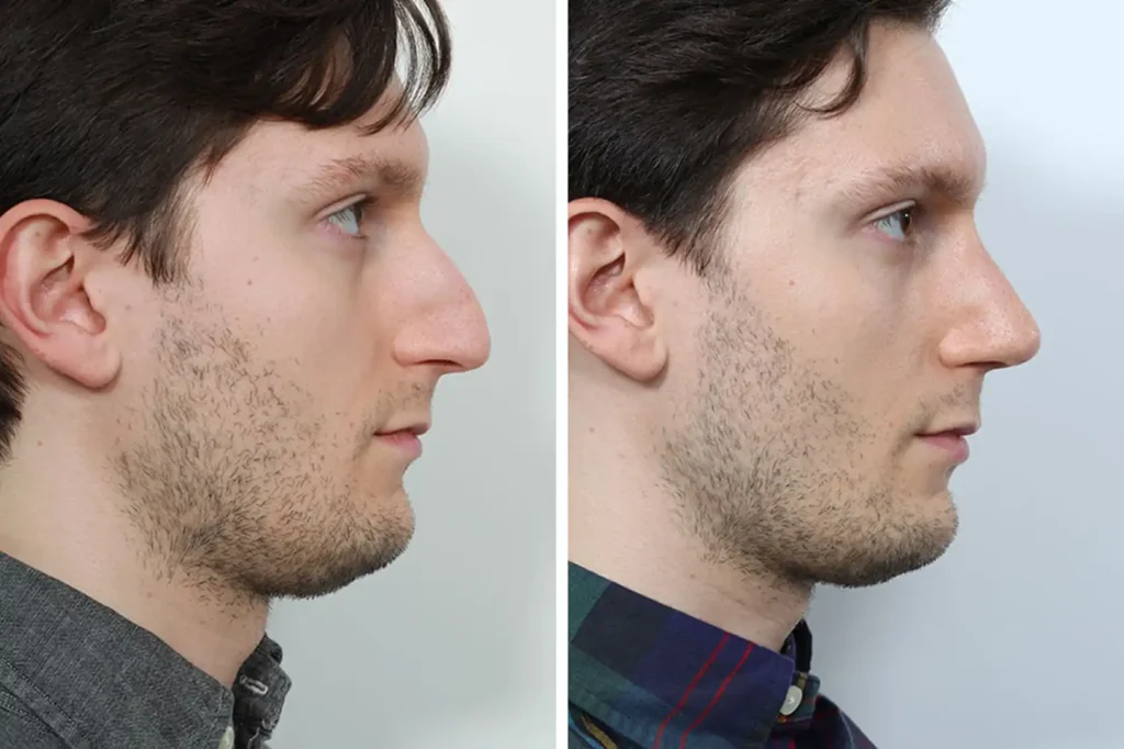 rhinoplasty before and after male