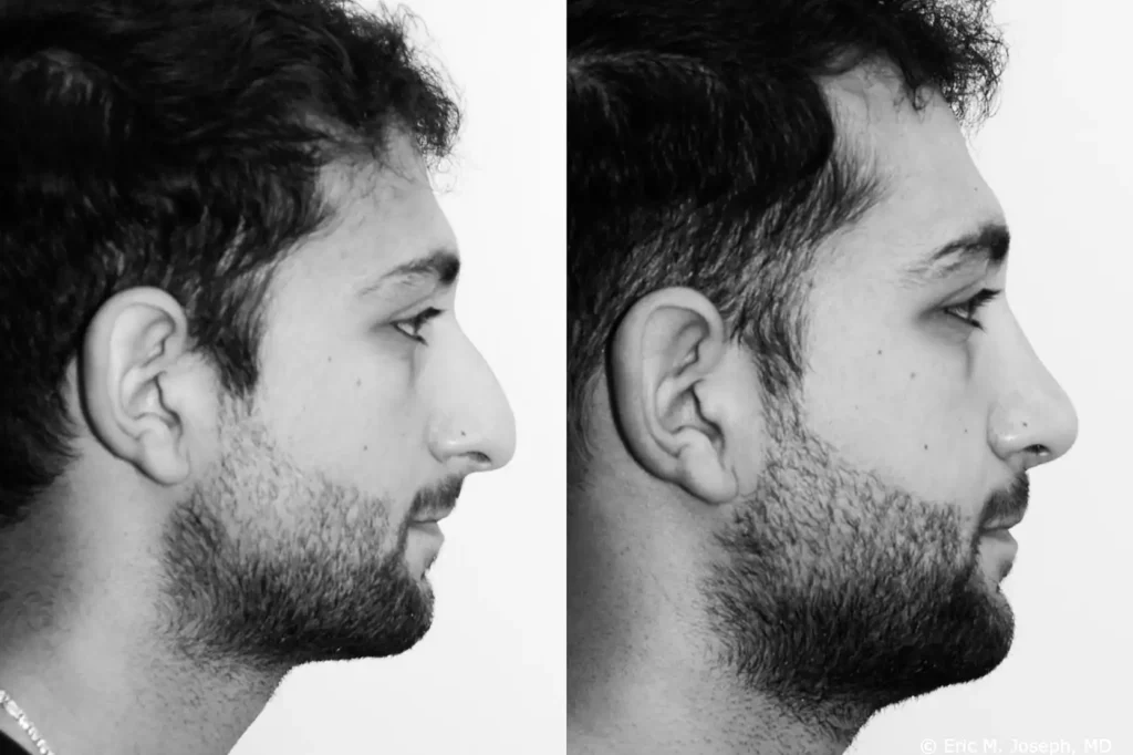 rhinoplasty before and after male