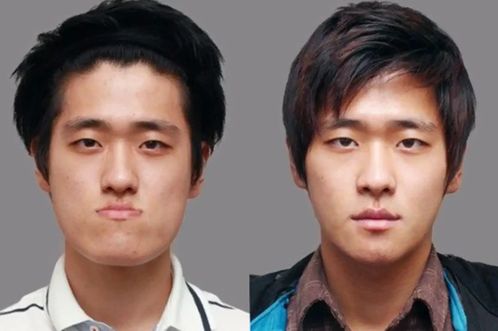 south korea cosmetic surgery before and after