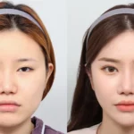 south korea cosmetic surgery before and after