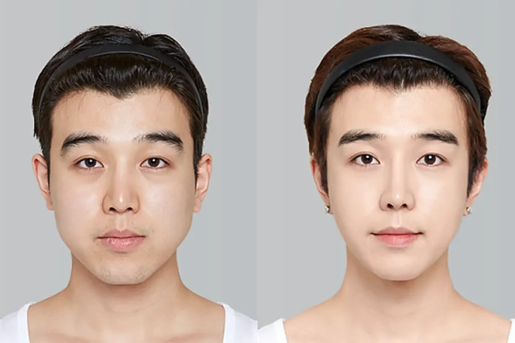 south korea cosmetic surgery before and after