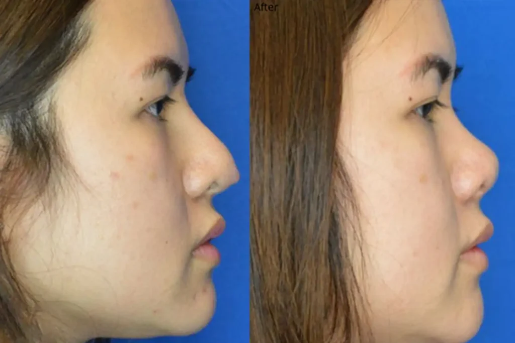 vanderbilt cosmetic surgery before and after