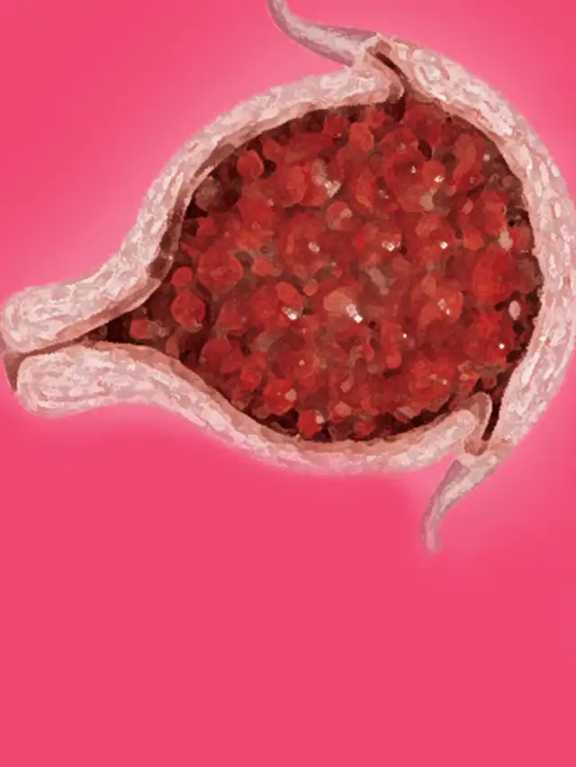 Is Gestational Trophoblastic Disease Cancer