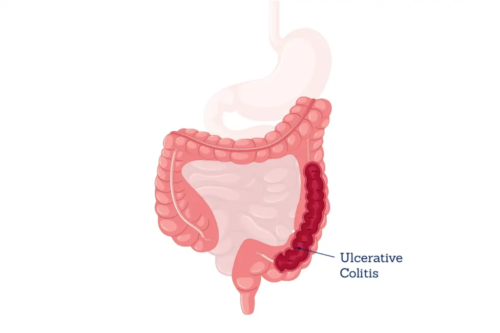 Ulcerative Colitis