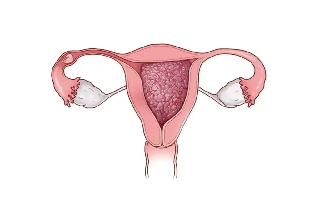 When Does Gestational Trophoblastic Disease Occur