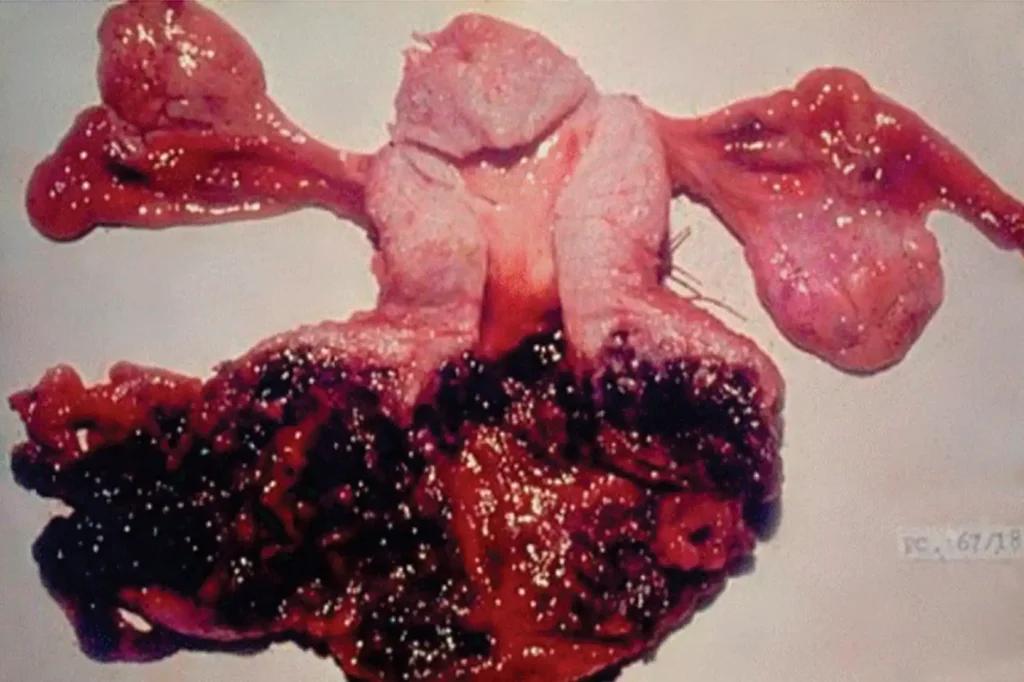 how rare is gestational trophoblastic disease