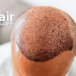 How Much Does a Hair Transplant Cost in USA