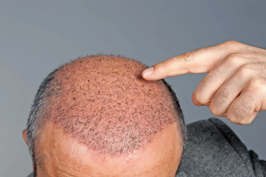 How Much Does a Hair Transplant Cost in USA