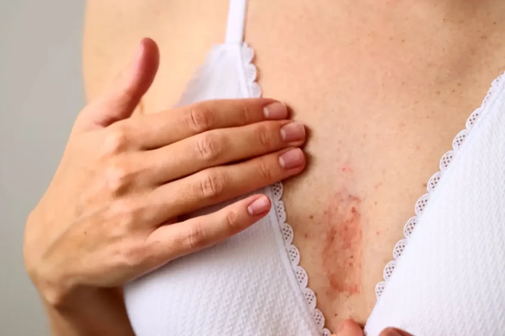 Inflammatory Breast Cancer Rash