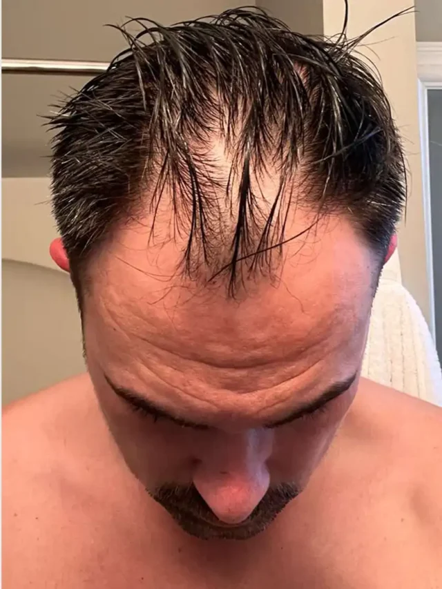How Much Does A Hair Transplant Cost in USA?