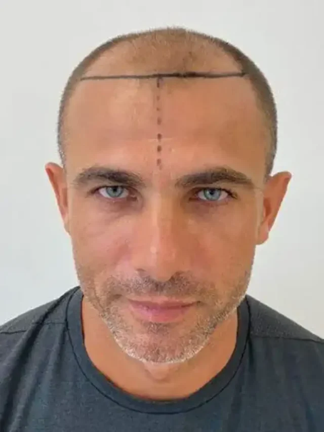 How Much Does A Hair Transplant Cost In Turkey