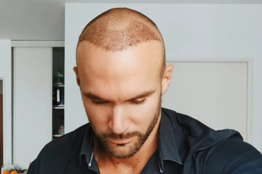 hair transplant before and after