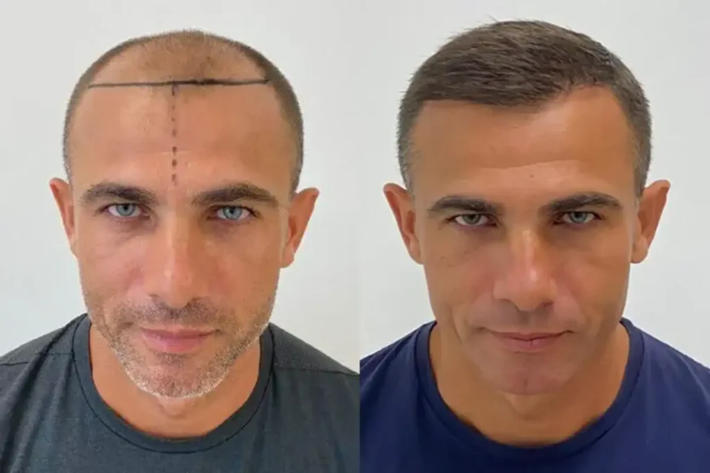 how much does a hair transplant cost in turkey