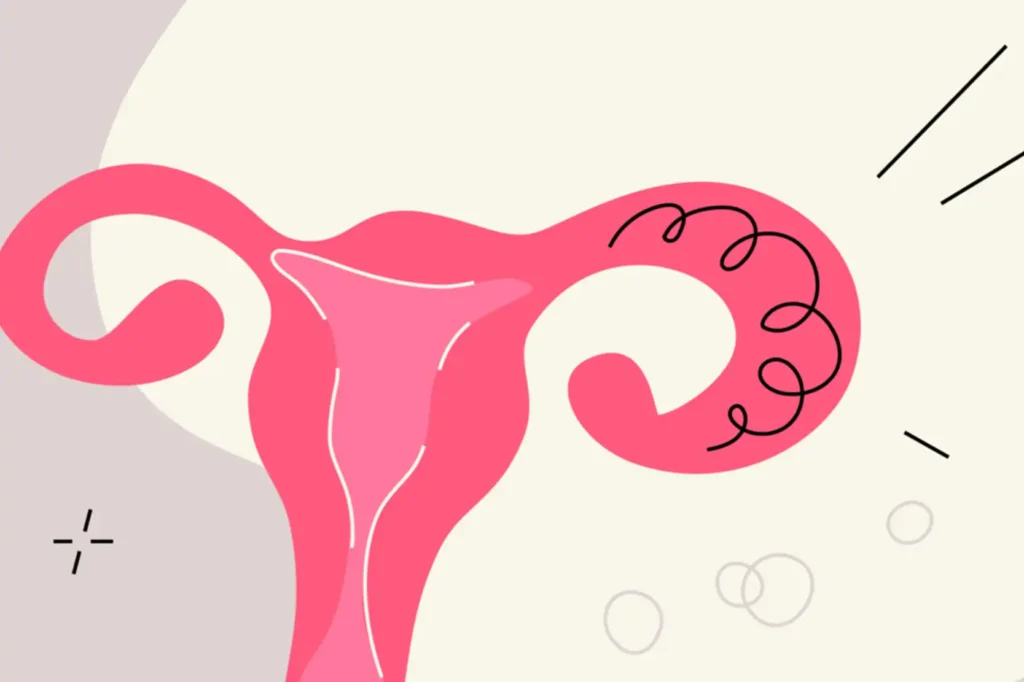 How to Treat Pelvic Inflammatory Disease
