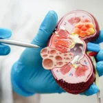 Modification of Diet in Renal Disease