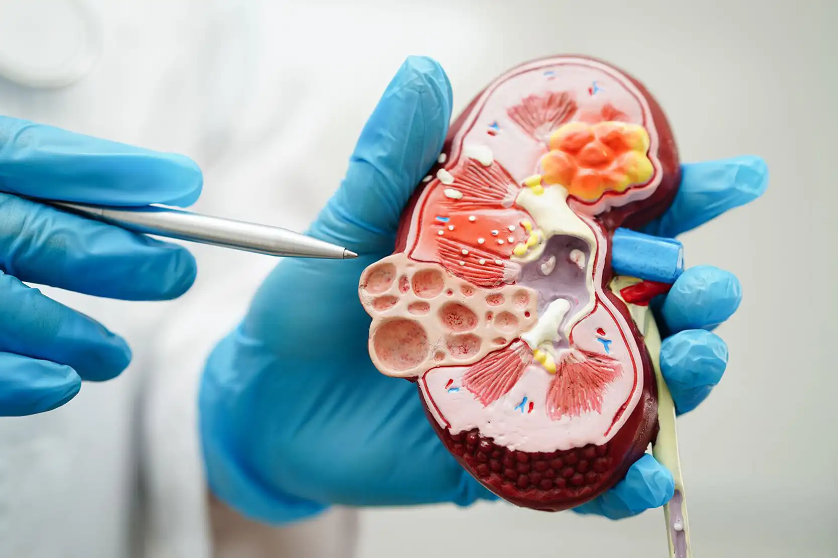 Modification of Diet in Renal Disease