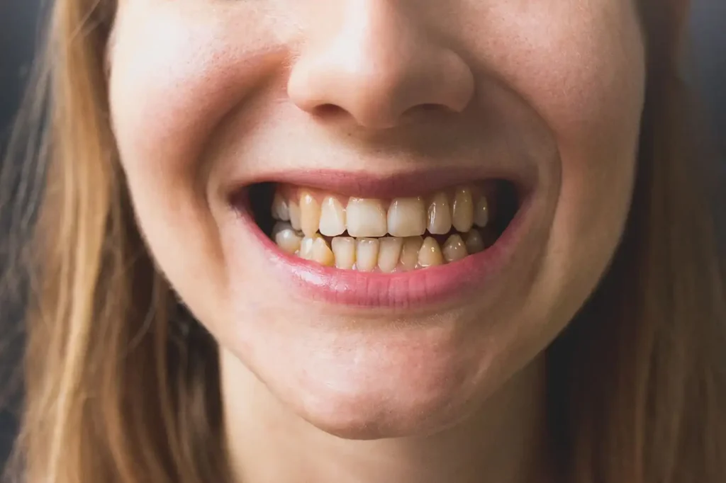 Ozempic Teeth Decay Risks and Prevention