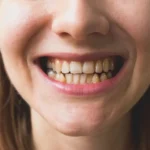 Ozempic Teeth Decay Risks and Prevention