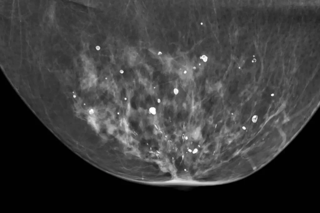 What is Calcification in the Breast