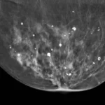 What is Calcification in the Breast