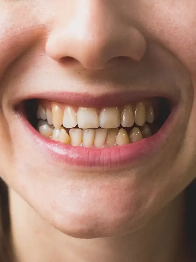 Ozempic Teeth Decay Risks and Prevention
